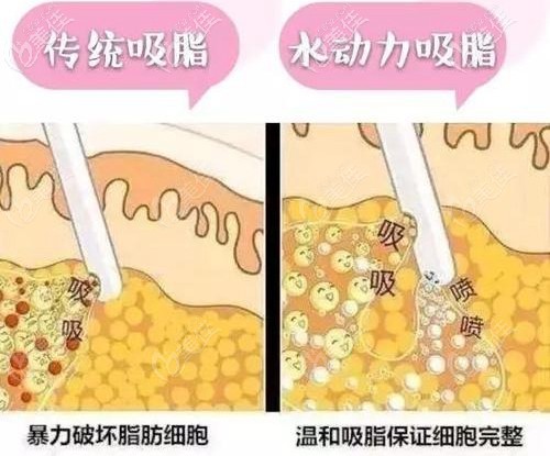 水动力吸脂的优势
