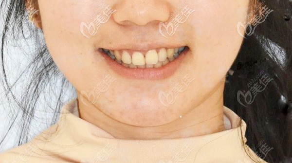 在秦皇岛蓝天口腔矫正龅牙,没打骨钉,戴口外弓内收前牙的效果也很赞哦