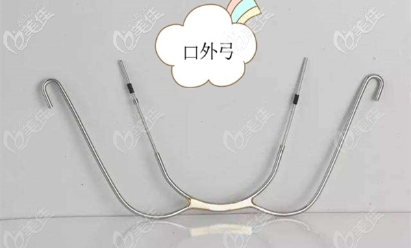 正畸口外弓介绍