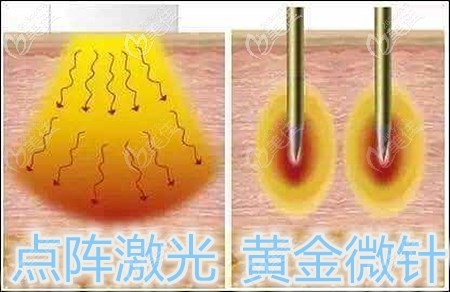 黄金微针和点阵哪个好