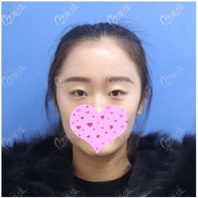 双眼皮手术前 双眼皮手术前