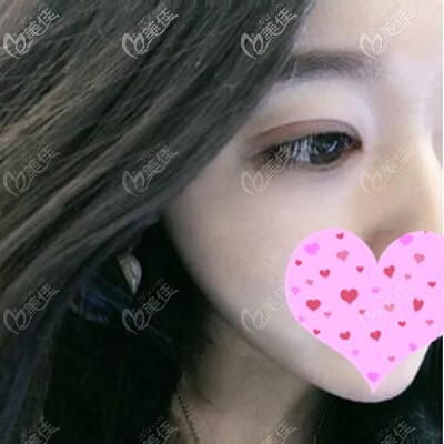 找王莉莉做双眼皮术后 找王莉莉做双眼皮术后