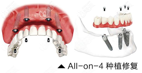 All-on-4即刻种植图示