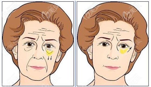 下拉皮手术能去泪沟和法令纹吗