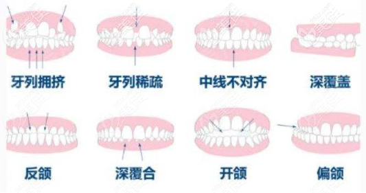 错颌畸形的不同类型