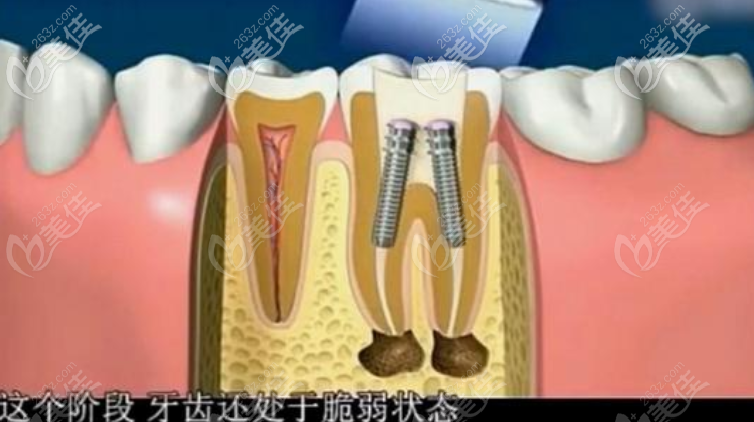 牙齿根管治疗图示 牙齿根管治疗图示