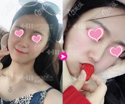 注射玻尿酸隆鼻术前术后对比照 注射玻尿酸隆鼻术前术后对比照