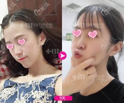 注射玻尿酸隆鼻术后9天照 注射玻尿酸隆鼻术后9天照