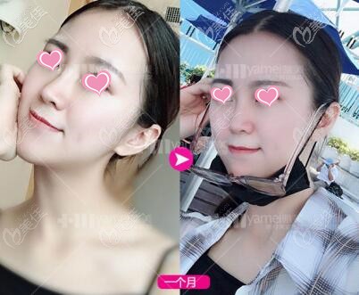 玻尿酸隆鼻术后1个月效果照 玻尿酸隆鼻术后1个月效果照
