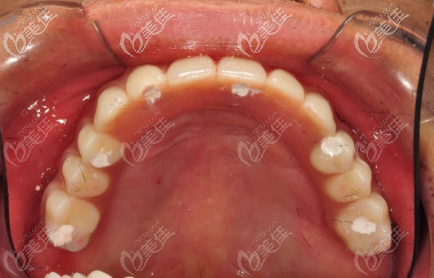 上颌种植后效果 上颌种植后效果