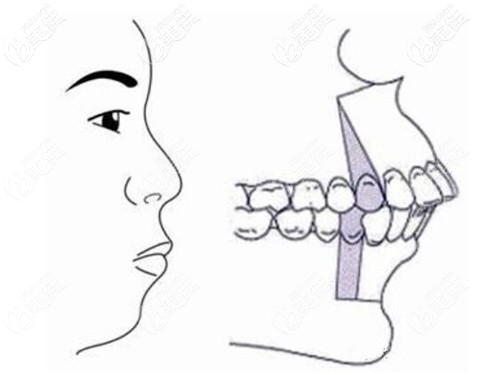 龅牙矫正 龅牙矫正