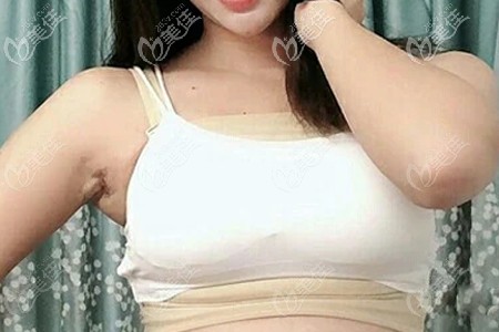 做完傲诺拉假体隆胸术后第十天照片 做完傲诺拉假体隆胸术后第十天照片