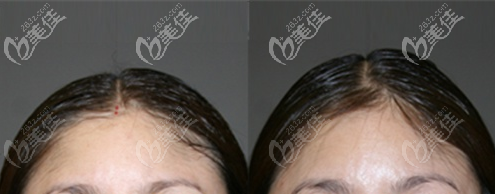 韩国颅顶增高手术案例:骨水泥填充头顶增高1cm