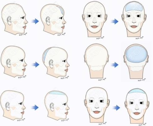 颅顶增高手术是怎么做的