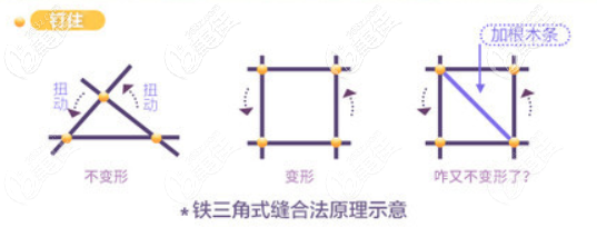铁三角缝合法图示 铁三角缝合法图示
