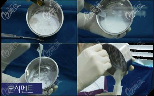 颅顶增高手术（骨水泥垫头顶）手术过程图