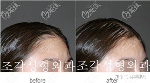 韩国雕刻整形外科医院宋龙泰骨水泥填充头顶案例效果