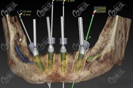 allon4种植牙图解
