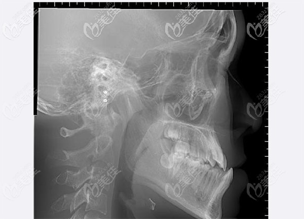 儿童牙齿对刃，反颌情况明显