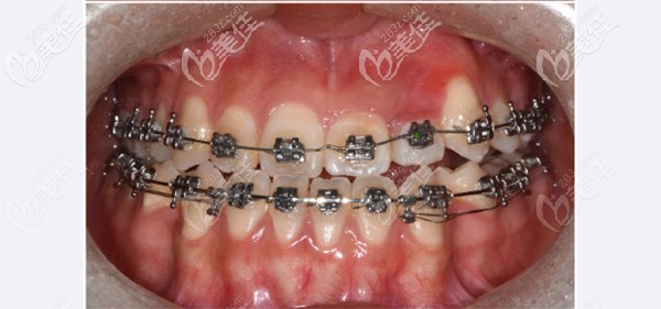 戴上牙套后娃的牙齿