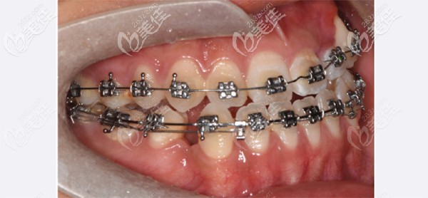 宝妈分享贴：儿童牙齿对刃是怎么矫正比较好？