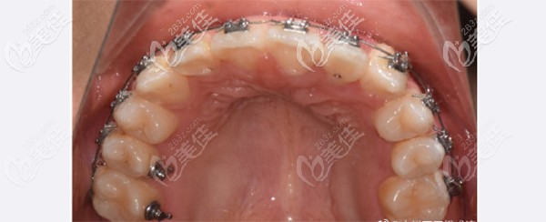 半年后牙齿对刃金属牙套矫正