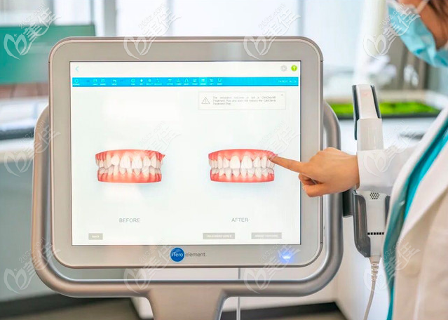 Four Smile隐形牙齿矫正免费iTero口腔扫描