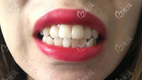 牙齿还算整齐，但嘴巴很突