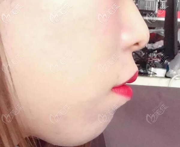 侧面看嘴巴突的很厉害，下巴都没了