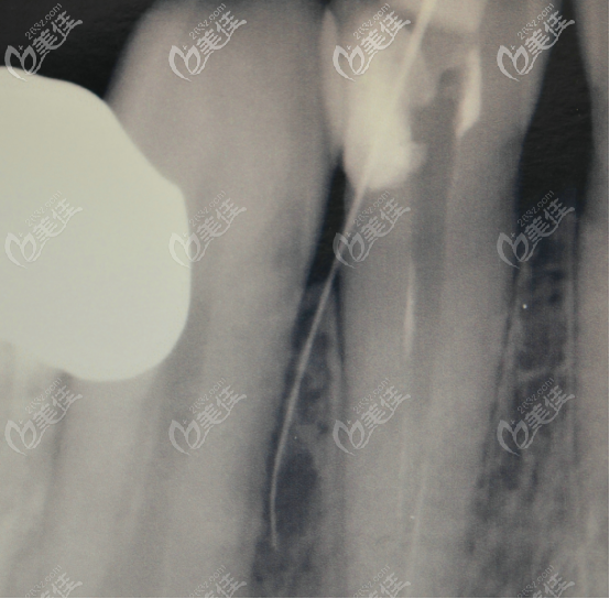 牙胶尖拍摄的光片