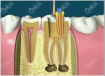 根管填充示意图