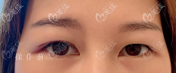 因为贴双眼皮贴导致眼皮松弛出现“双眼皮” 因为贴双眼皮贴导致眼皮松弛出现“双眼皮”