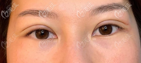 南充艾迪曾少林切开双眼皮术后效果 南充艾迪曾少林切开双眼皮术后效果