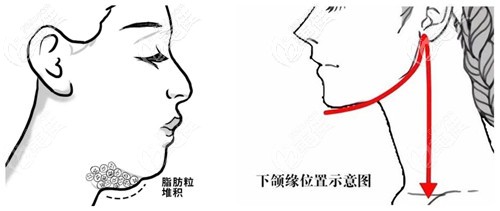 双下巴吸脂和下颌缘吸脂可以同时进行