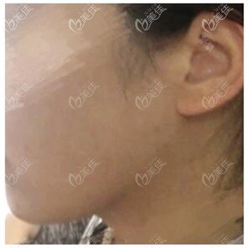 双下巴和下颌缘同时吸脂后