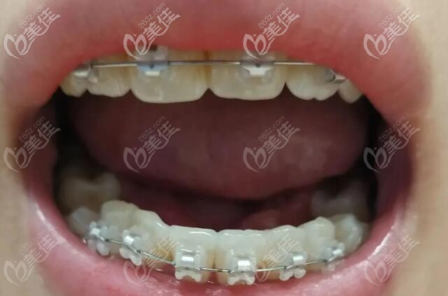 梅州中大口腔正畸案例:下排牙齿拥挤错乱的矫正效果