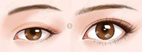 双眼皮提肌手术效果