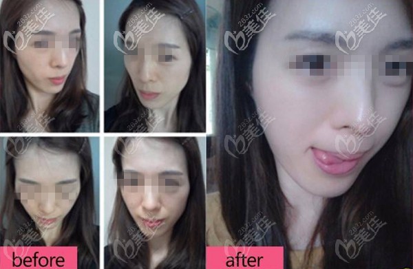 北京南加DGS四维青春复原术案例 北京南加DGS四维青春复原术案例