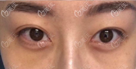 郑楠手术祛眼袋10天图片