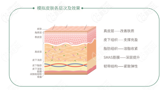 面部提升线“紧恋” 面部提升线“紧恋”