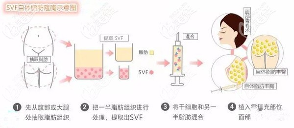 芘丽芙贵美人做SVF自体脂肪填充脸颊