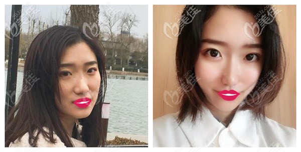 石家庄芘丽芙贵美人做SVF自体脂肪填充脸颊案例