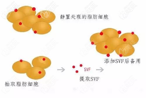石家庄面容管家做SVF自体脂肪填充过程