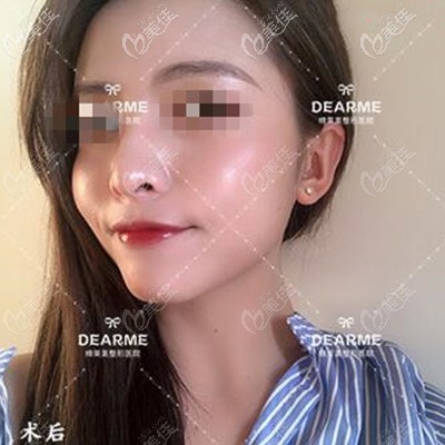 下颌缘光纤溶脂术后1个月