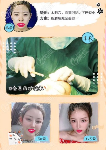 面容管家做SVF自体脂肪填充脸颊案例