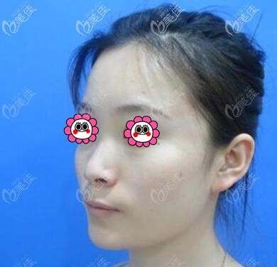 艾莉薇玻尿酸隆鼻术前照 艾莉薇玻尿酸隆鼻术前照