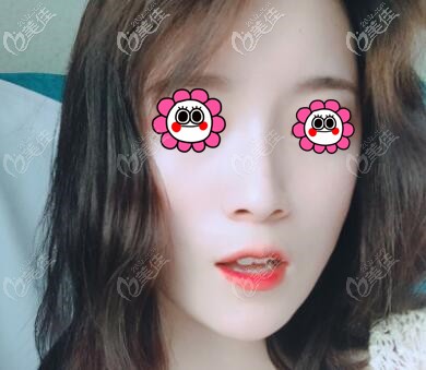 艾莉薇玻尿酸隆鼻术后5天恢复照 艾莉薇玻尿酸隆鼻术后5天恢复照
