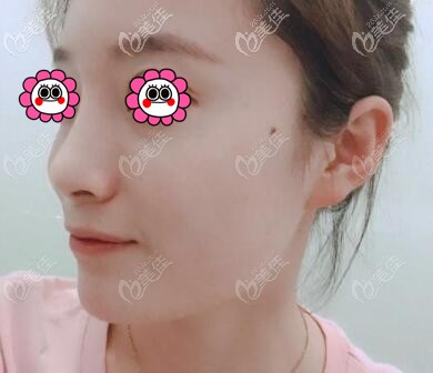 没想到在沈阳名流注射艾莉薇玻尿酸隆鼻后的效果比我预想的要好！