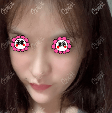 在北京蒂凡妮医疗美容做全脸脂肪填充有8天了