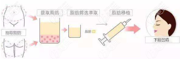 下眼睑凹陷脂肪填充手术示意图 下眼睑凹陷脂肪填充手术示意图